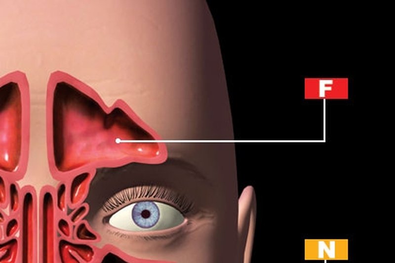 F: Frontalni sinus
N: Nosne školjke
M: Masilarni sinus (foto: 3D Clinic/Mix)