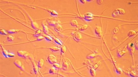 Sperma rumene barve kot bolezenski znak