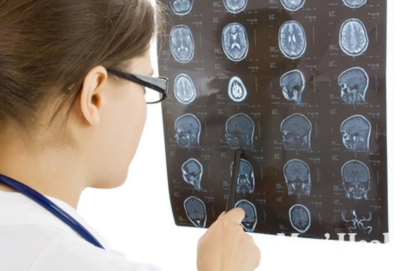 Debelost škodi možganom (foto: Shutterstock.com)