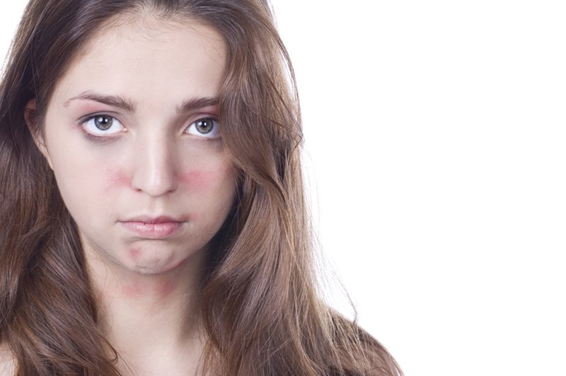 Atopični dermatitis pri otroku – bitka za vso družino (foto: Shutterstock.com)