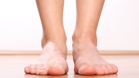 Ploska stopala - vzrok za bolečine v hrbtu
