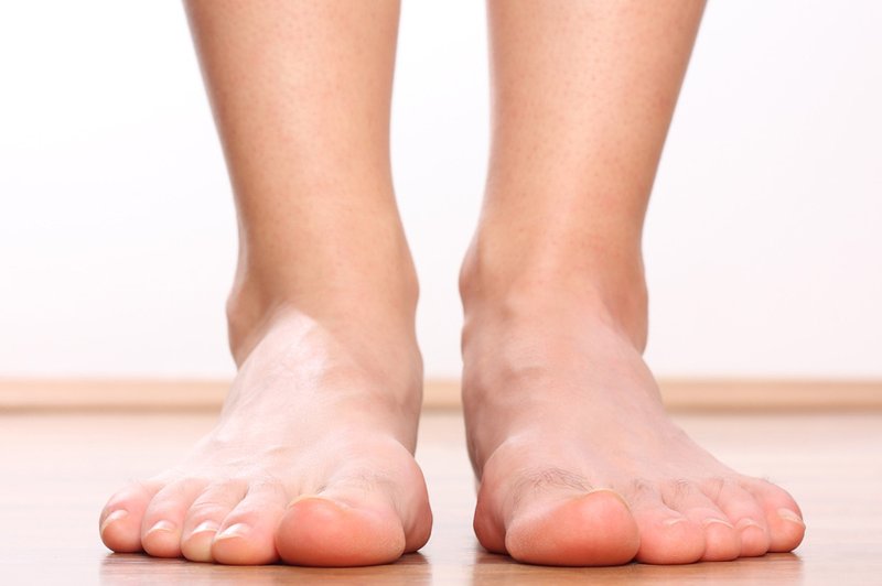 Ploska stopala - vzrok za bolečine v hrbtu (foto: Shutterstock.com)