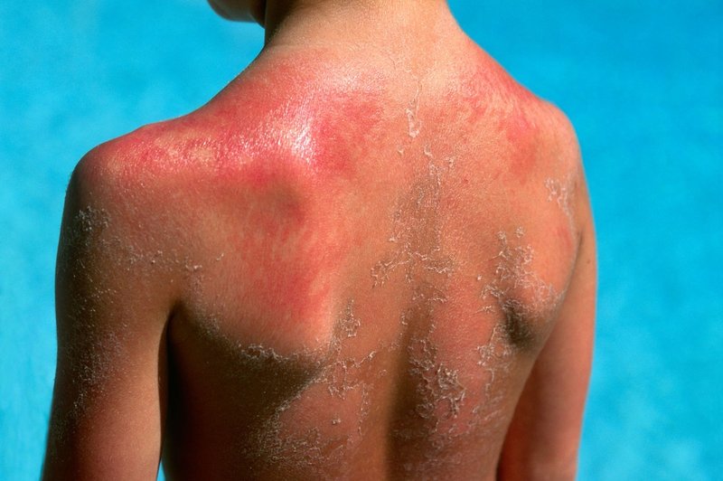 Kako ravnati pri sončnih opeklinah (foto: Profimedia)