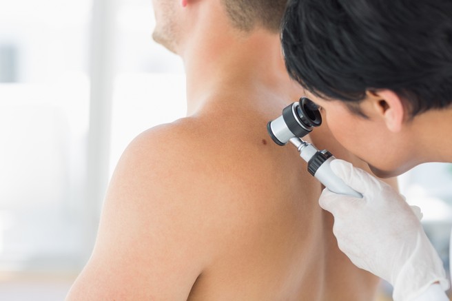 Evropski teden boja proti melanomu - letos posvečen moškim 50+