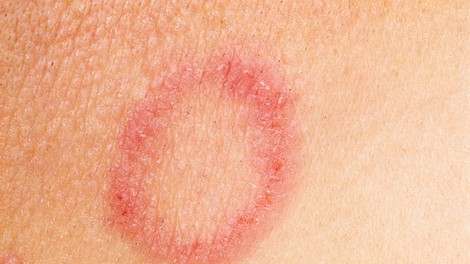 5 zoprnih kožnih bolezni in okužb, ki jih lahko staknete v telovadnici