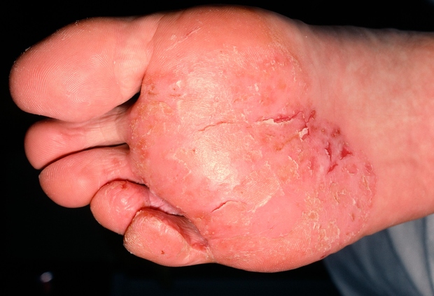 Atletsko stopalo Je glivična okužba stopala. Pojavi se v treh različnih oblikah: med prsti, na podplatih in v vezikulobulozni obliki. …