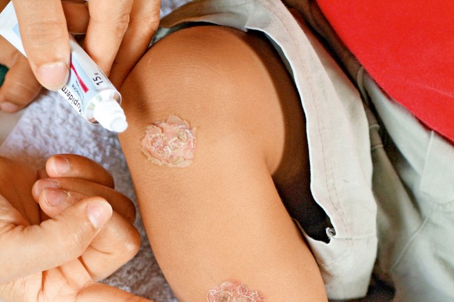 Impetigo – bolezen otrok