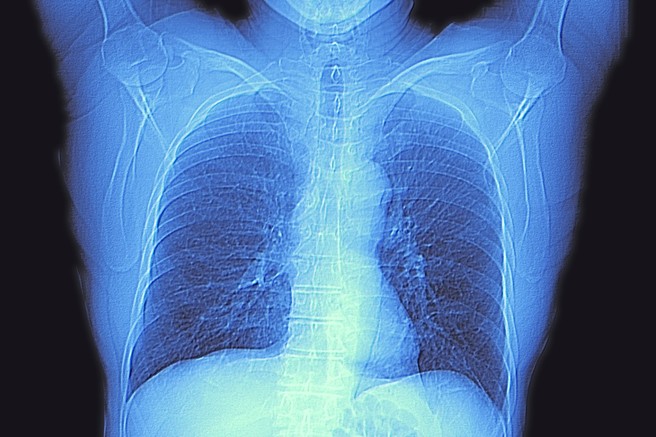 Njujorškim zdravnikom uspel preboj v diagnostiki okužbe z novim koronavirusom
