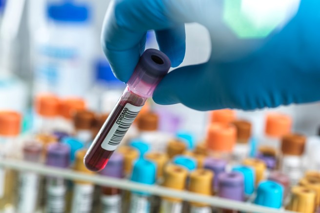 V postopku testiranja krvi test, s katerim bi lahko odkrili kar 50 vrst raka