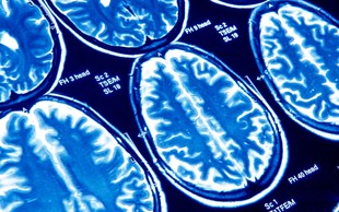 Covid-19 lahko povzroči trajne poškodbe možganov (zdaj pa tudi že vemo, zakaj)