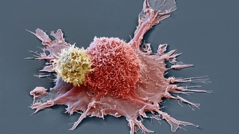 Onkologi so osupnili: VSEM pacientom v raziskavi IZGINIL TUMOR!