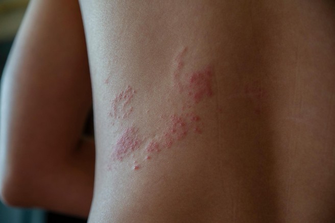 Herpes zoster: Opozorilni znaki, ki se pojavijo nekaj dni pred izpuščajem – med njimi je tudi zobobol! Obiščite zdravnika!