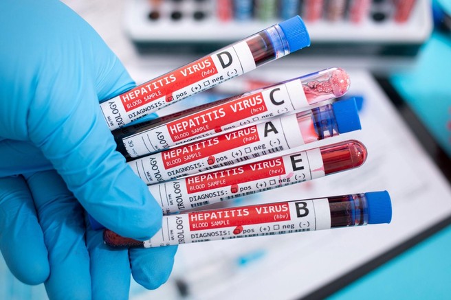 Hepatitis in vse, kar morate vedeti o njem – vrste, kako se prenaša, simptomi, kateri je najnevarnejši in kateri ozdravljiv