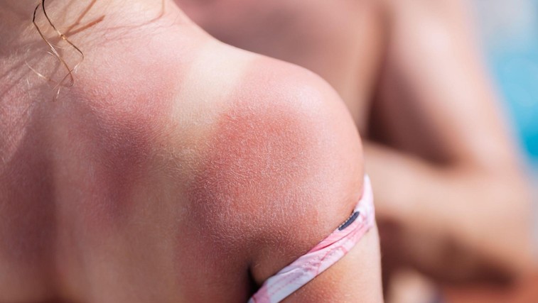 Vročinski izpuščaji ali alergija na sonce? To so razlike! (foto: Profimedia)