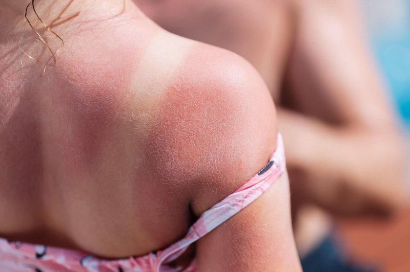 Vročinski izpuščaji ali alergija na sonce? To so razlike! (foto: Profimedia)
