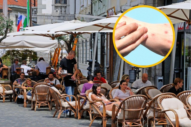 V Sloveniji že več kot 40 potrjenih primerov opičjih koz: najbolj izpostavljena TA skupina