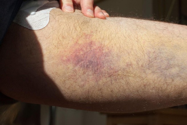 TAKO zmanjšate tveganje za nastanek krvnih strdkov!