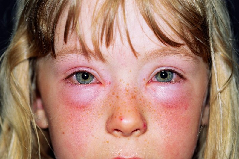 Alergija na hrano ali občutljivost? Tako ugotovite razliko