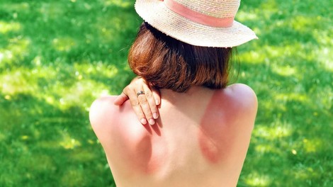 Tako sončne opekline škodijo zdravju dolgo potem, ko zbledijo (posledice so precej hude)