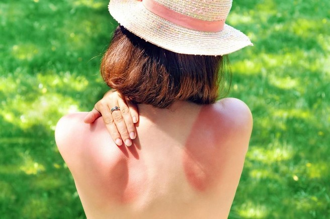 Tako sončne opekline škodijo zdravju dolgo potem, ko zbledijo (posledice so precej hude)