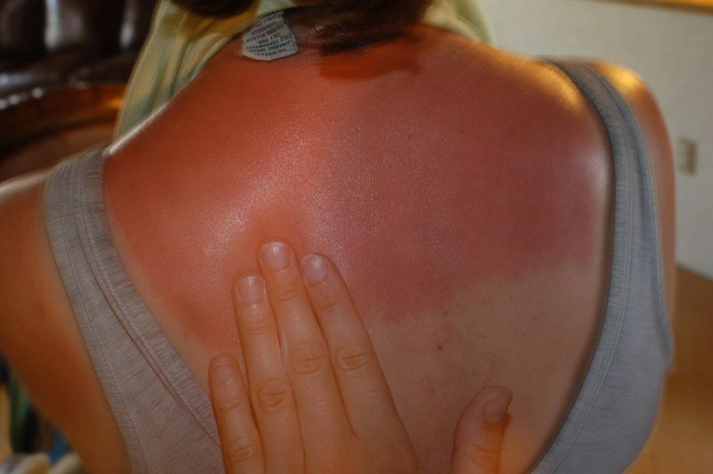 Ste vedeli, da ste bolj dovzetni za sončne opekline, če jeste to? 👇 (foto: profimedia)