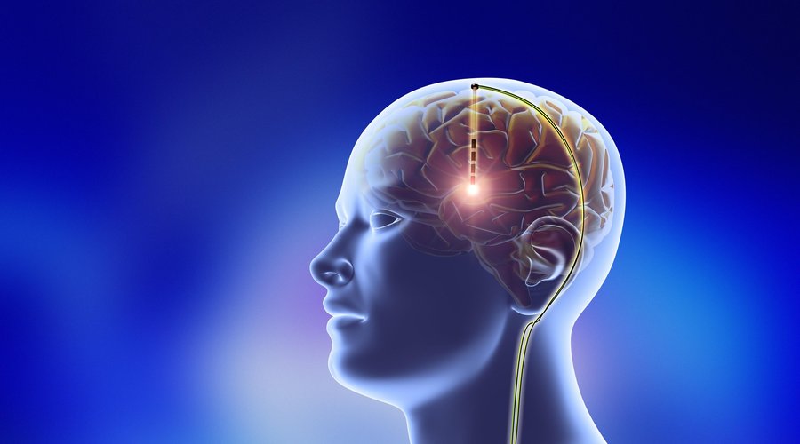 Parkinsonova bolezen povzroči odmiranje živčnih celic v delu možganov, ki jih nadzoruje, zaradi pomanjkanja hormona dopamina.