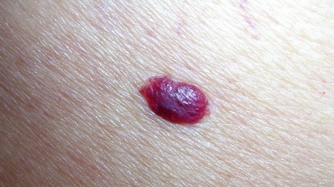 Če na svoji koži opazite takšne rdeče pike, bodite pozorni – to je čas, ko morate nujno obiskati zdravnika!
