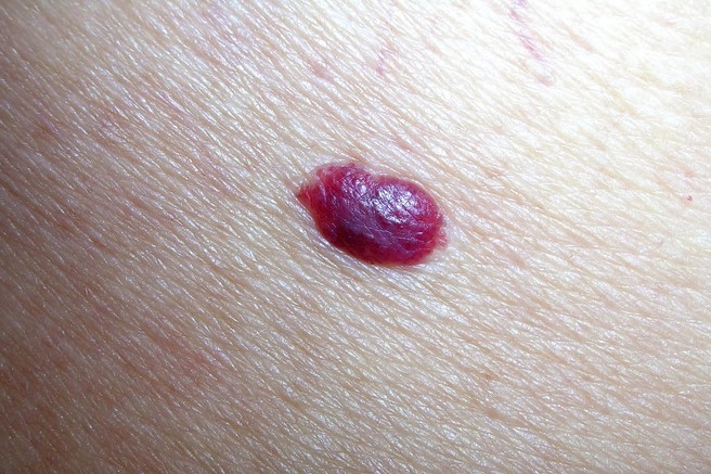 Cherry angioma - rdeče znamenje na koži