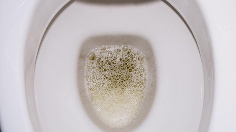 Bi vas moralo skrbeti, če se vaš urin peni? Ja, lahko je tudi resen opozorilni znak, ki zahteva takojšnje ukrepanje!