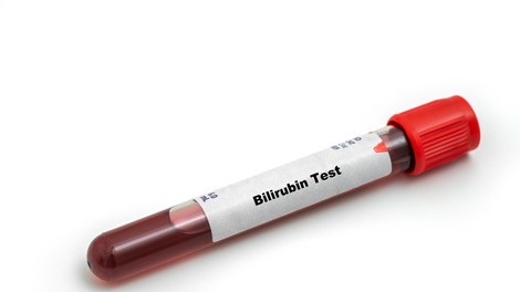 Bilirubin test