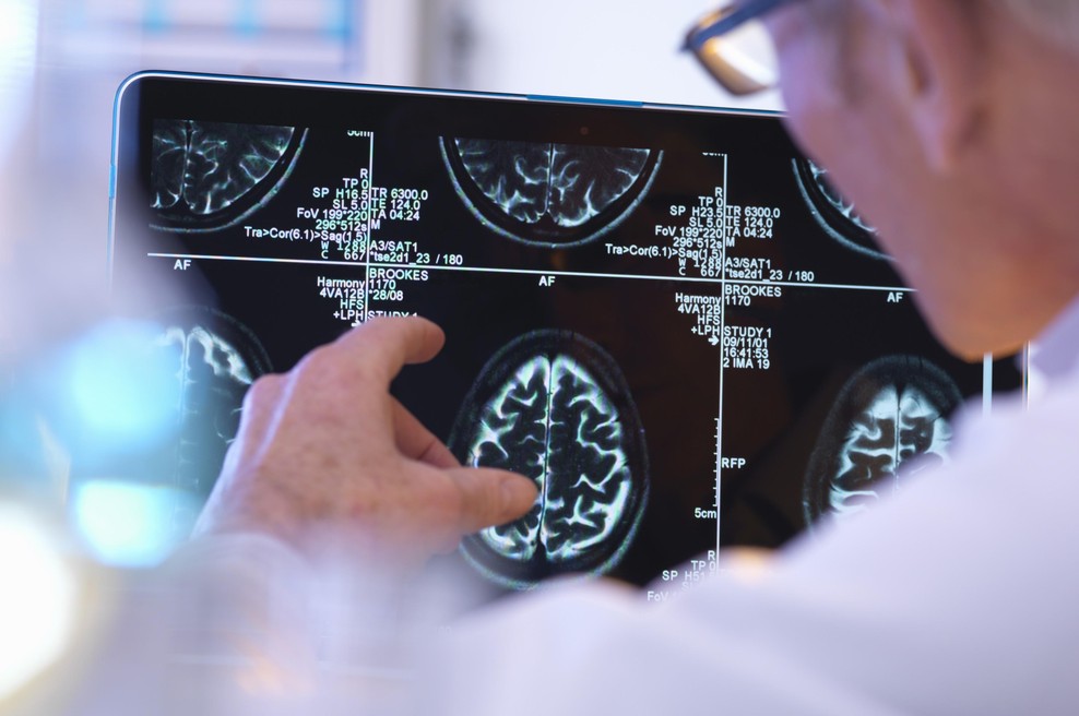 Verjamete vanje? To je 10 najpogostejših mitov in zmot o možganski kapi (foto: Profimedia)