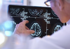 Verjamete vanje? To je 10 najpogostejših mitov in zmot o možganski kapi