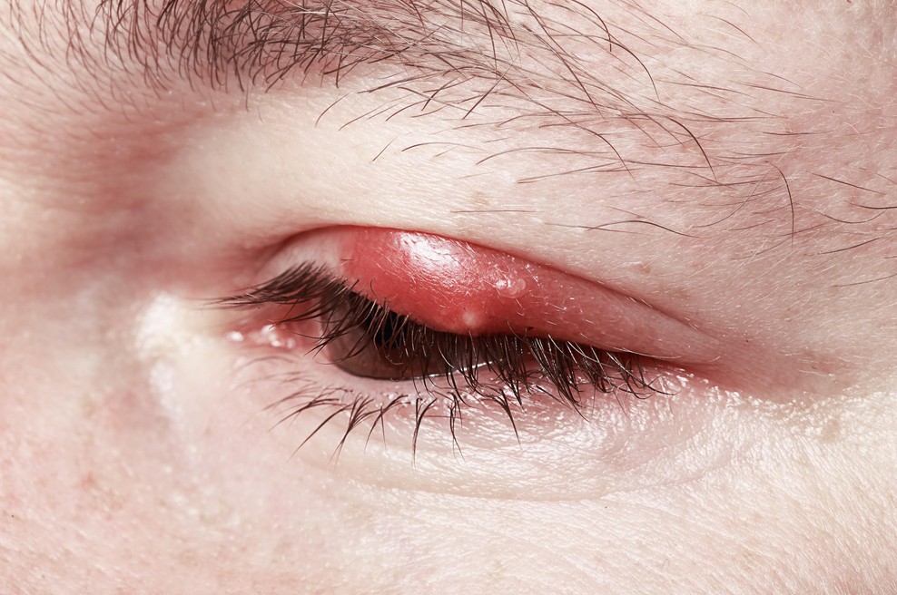 Pozabite na antibiotike: ta naravni trik v hipu odpravi ječmen na očesu (foto: Profimedia)