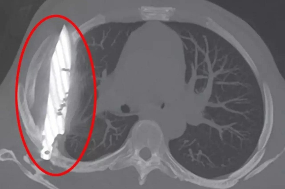 V bolnico je prišel zaradi težav s prsnim košem: zdravniki so naredili rentgen in ostali povsem šokirani (foto: Journal of Surgical Case Reports)