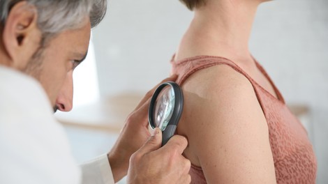Najpogostejša vrsta raka prizadene vsako peto osebo: dermatologinja svetuje, kako jo prepoznati in kako preprečiti nastanek