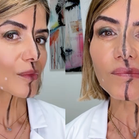 Zdravnica razkriva osupljive učinke botoksa: vbrizgala si ga je le na eno stran obraza in pokazala razliko (VIDEO)