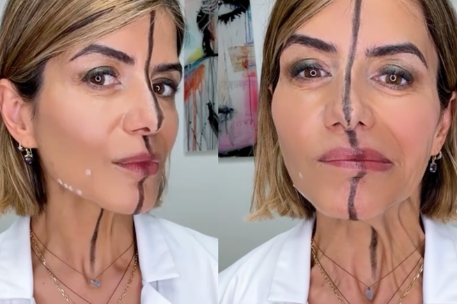 Zdravnica razkriva osupljive učinke botoksa: vbrizgala si ga je le na eno stran obraza in pokazala razliko (VIDEO)