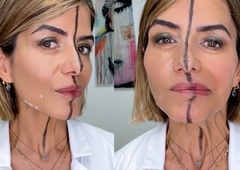 Zdravnica razkriva osupljive učinke botoksa: vbrizgala si ga je le na eno stran obraza in pokazala razliko (VIDEO)