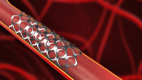 Kaj lahko pričakujete pred in po vstavitvi stenta? Od koristi do možnih zapletov