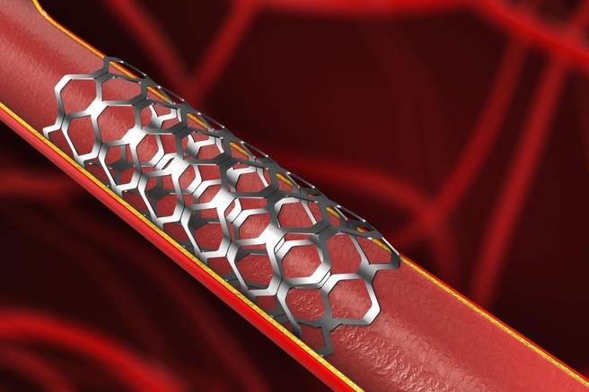 Kaj lahko pričakujete pred in po vstavitvi stenta? Od koristi do možnih zapletov