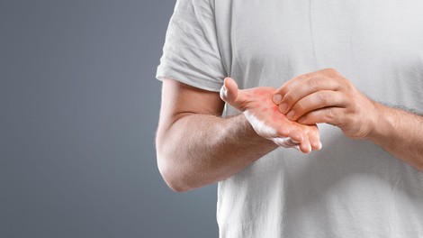 Zakaj vas srbijo dlani? Najpogostejši vzroki in znaki, ki jih ne smete prezreti