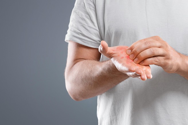 Zakaj vas srbijo dlani? Najpogostejši vzroki in znaki, ki jih ne smete prezreti